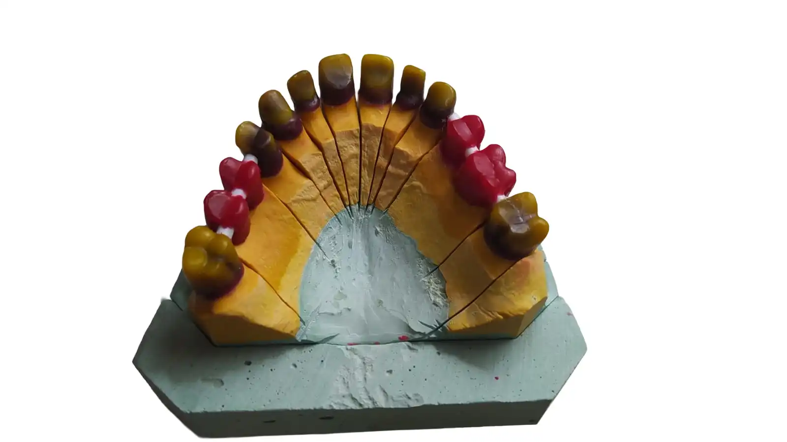 Finished dental implant bridge prosthetic showcase