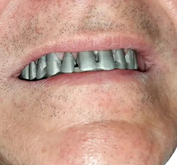 Precision dental laboratory wax model setup